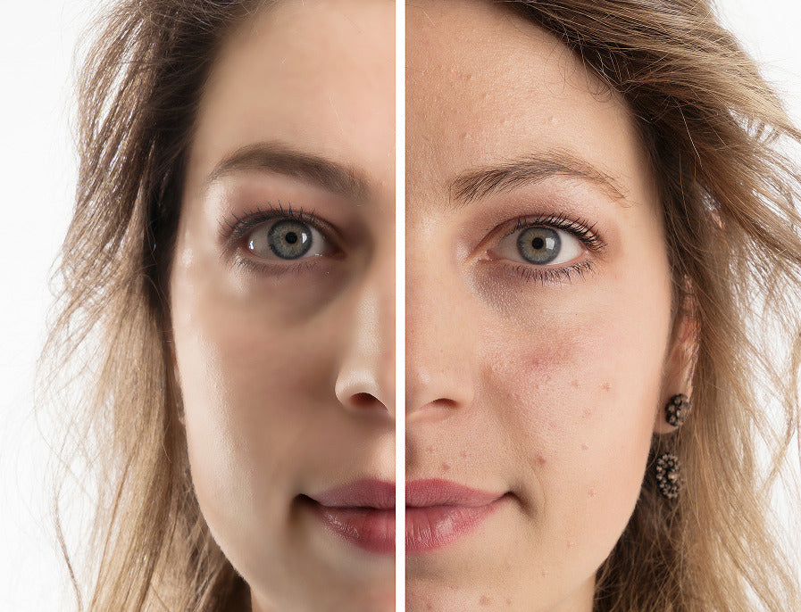 Woman before and after acne treatment with Celluma light therapy