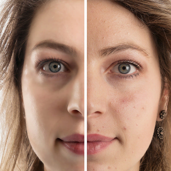 Woman before and after acne treatment with Celluma light therapy