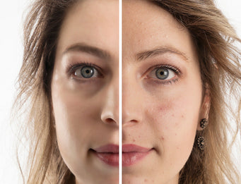 Woman before and after acne treatment with Celluma light therapy