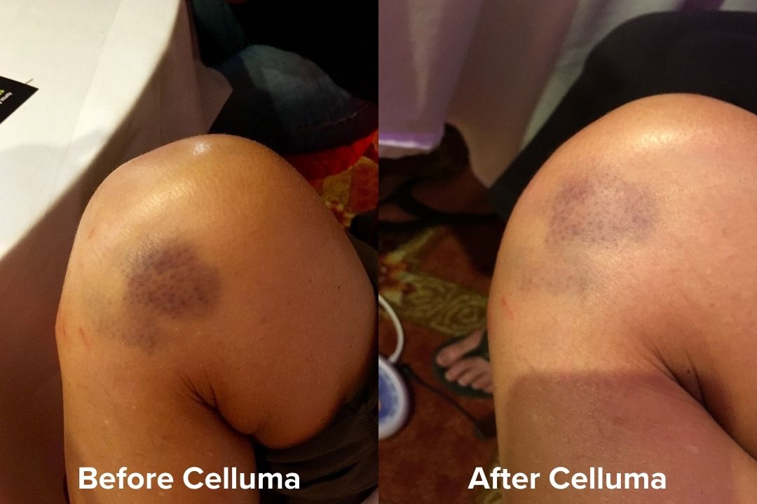 Bruise after one 30 minute Celluma treatment