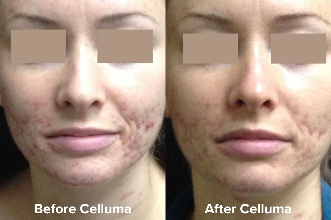 Led Light Treatment For Cystic Acne Shelly Lighting