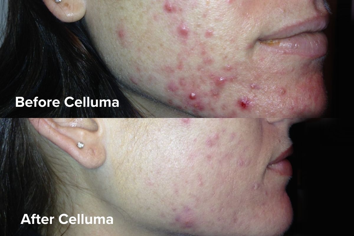 Celluma CLEAR LED Blue Light Therapy for Acne