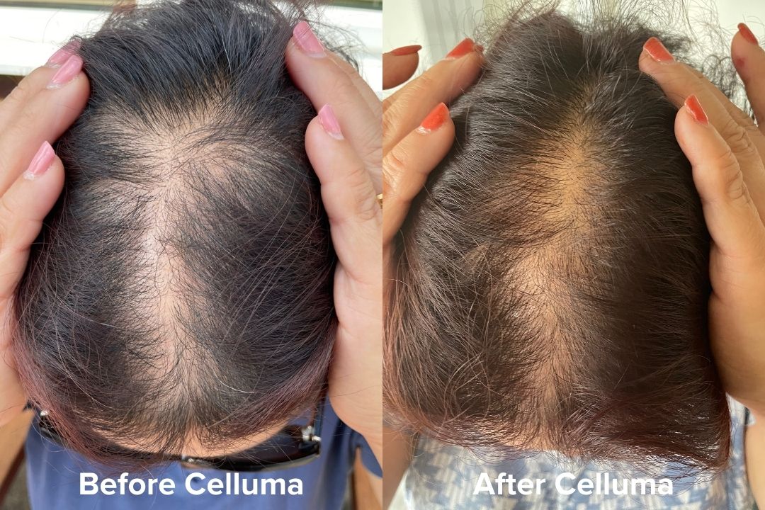 Red Light Therapy Hair Growth Before & After Results Celluma