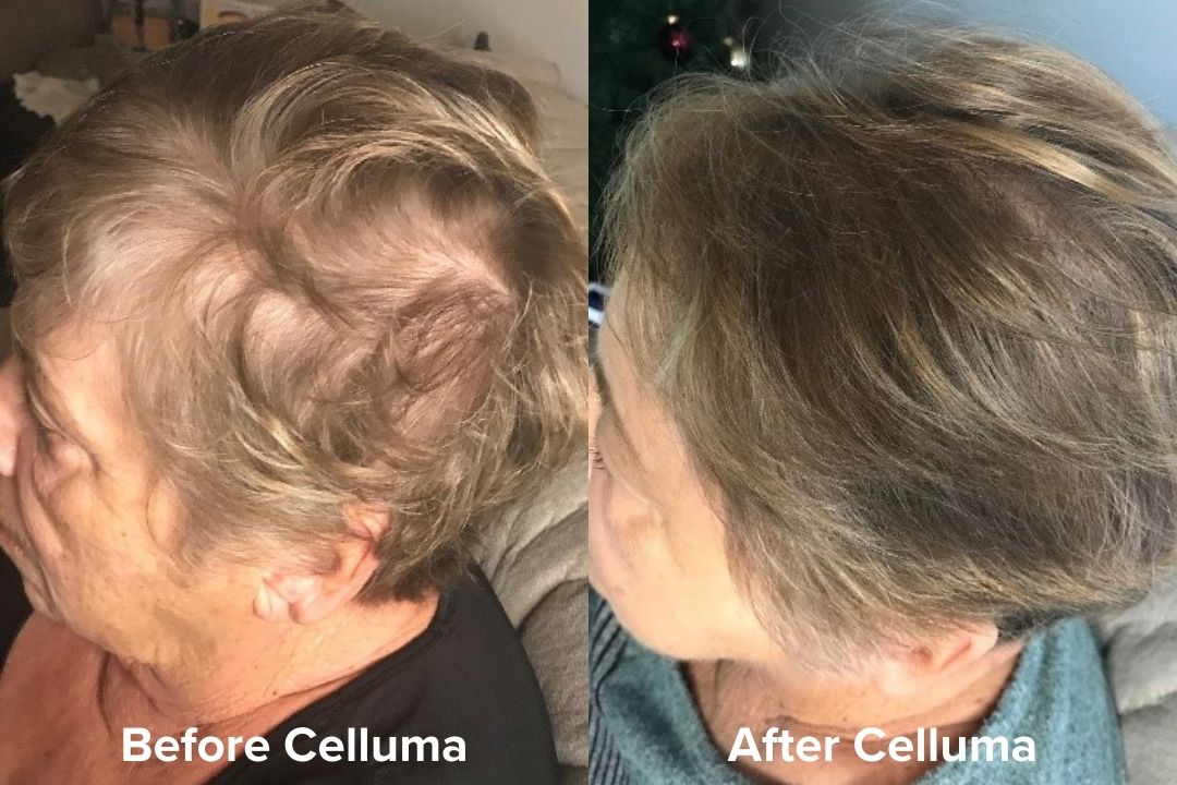 Red Light Therapy Hair Growth Before & After Results Celluma