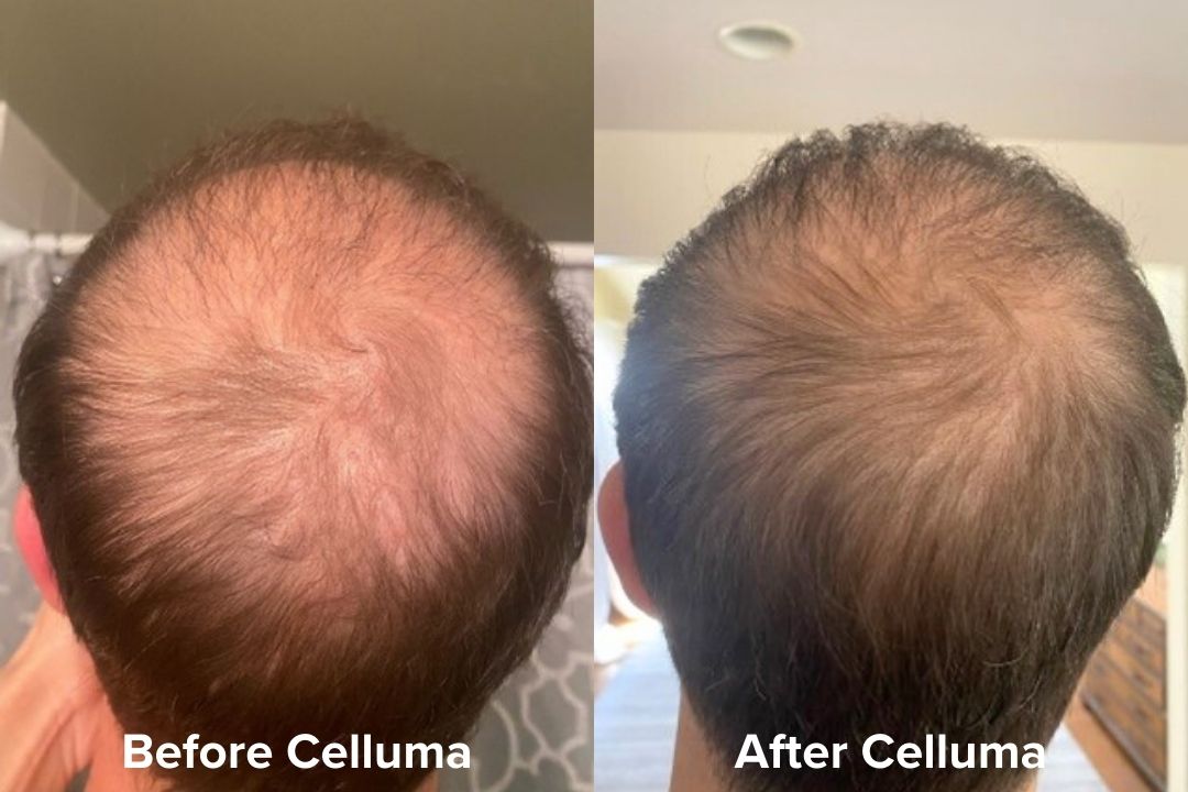 Red Light Therapy Hair Growth Before & After Results Celluma