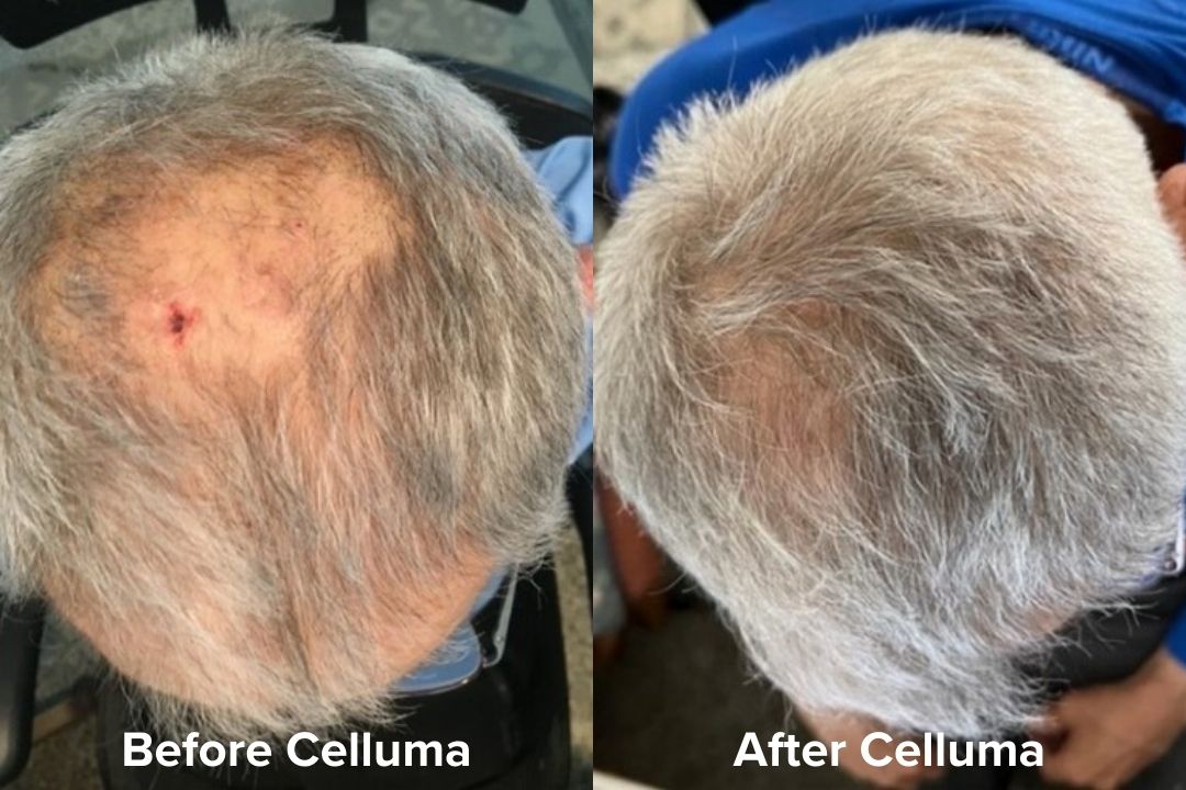 Red Light Therapy Hair Growth Before & After Results Celluma