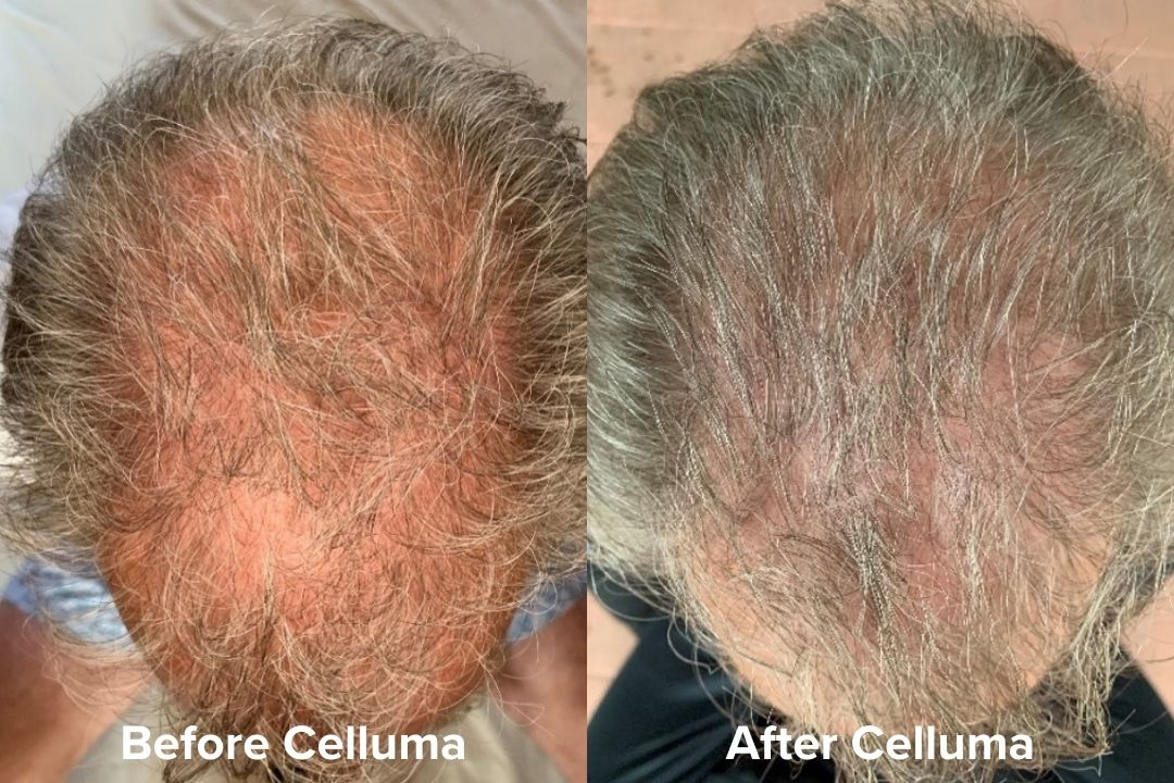 Red Light Therapy Hair Growth Before & After Results Celluma