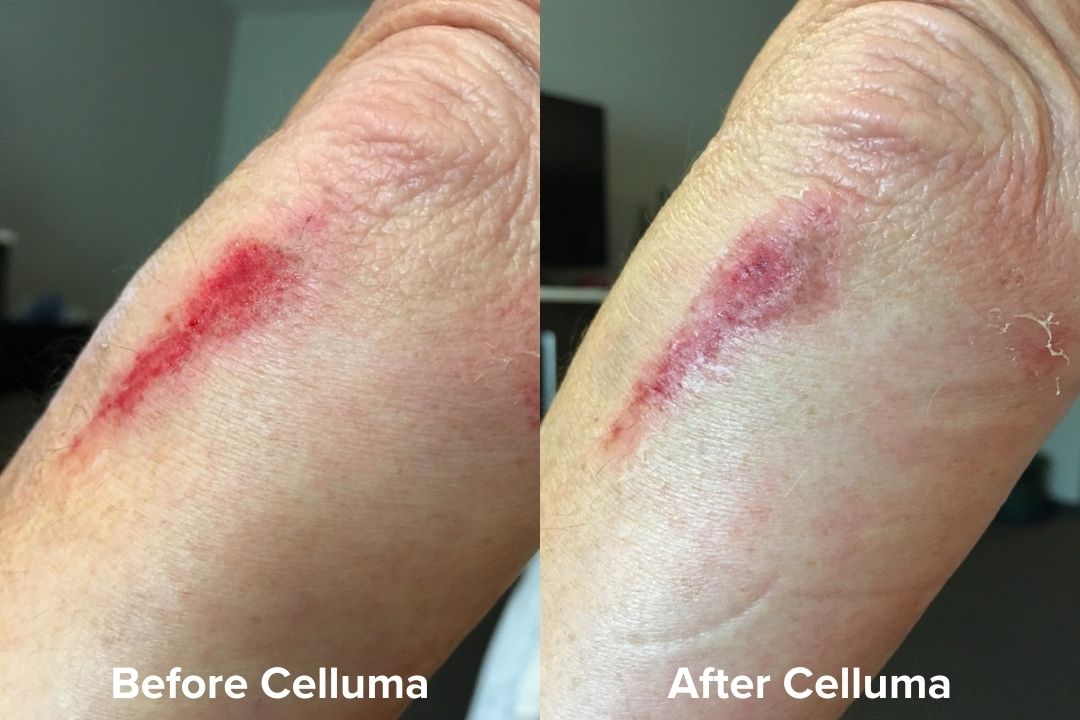 Red Light Therapy Wound Healing Before & After Images Celluma