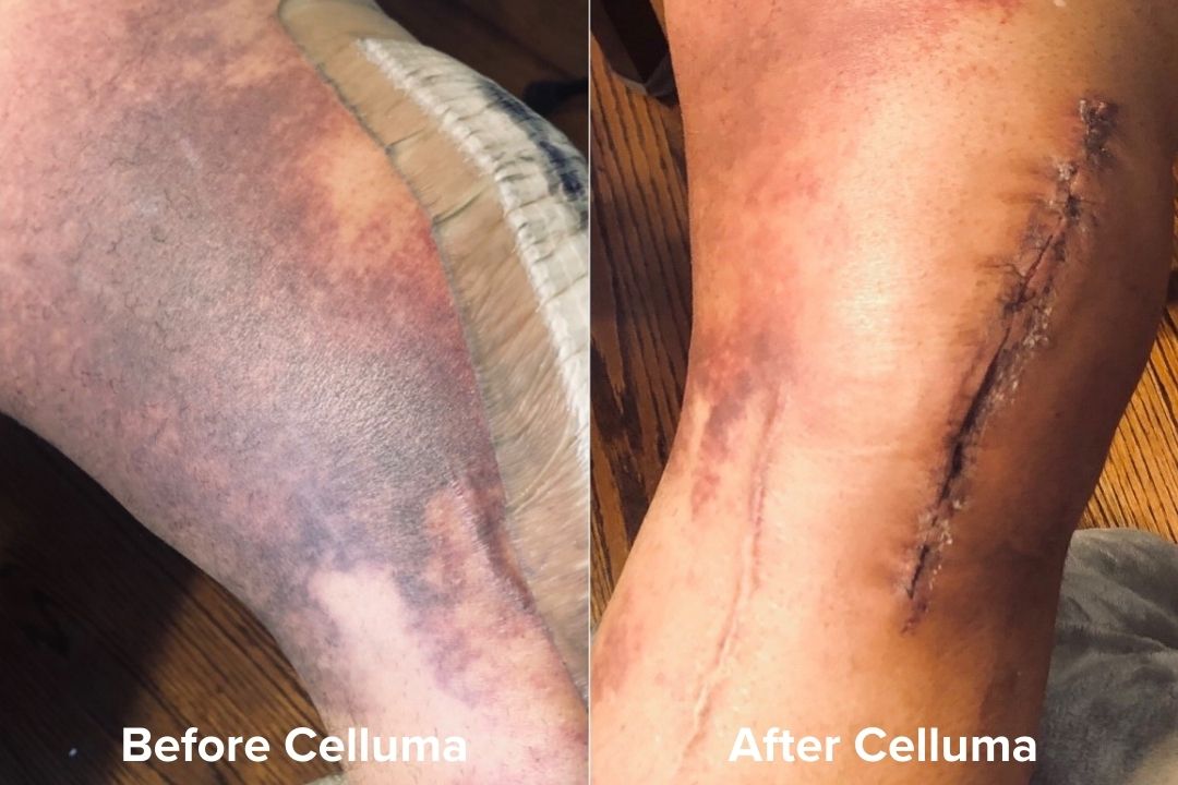 Red Light Therapy Wound Healing Before & After Images Celluma