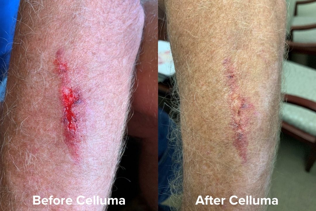 Red Light Therapy Wound Healing Before & After Images Celluma