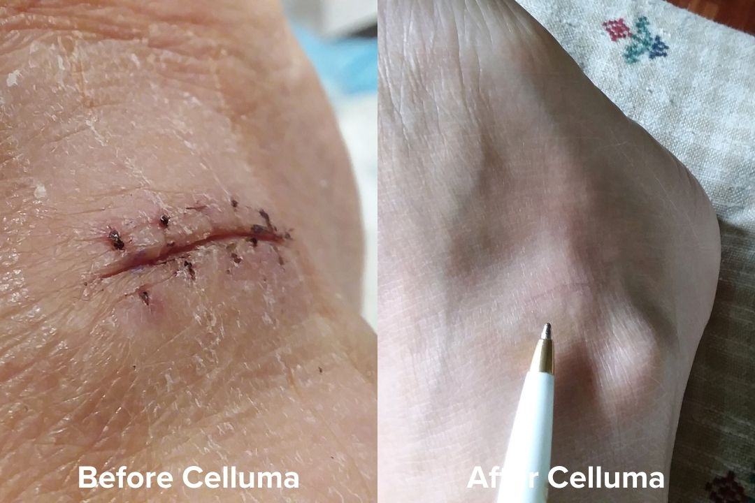 Red Light Therapy Wound Healing Before & After Images Celluma